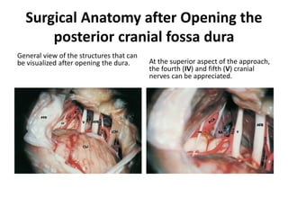General view of the structures in the
cerebellopontine angle
after opening the dura. Note the enhanced
exposure of the angle and
the excellent exposure of the trigeminal
nerve (V).
The trigeminal nerve (V) is
pushed superiorly. The basilar
artery (BA) in the prepontine
cistern can be seen well.
 