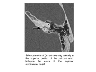 Subarcuate canal (arrow) coursing laterally in
the superior portion of the petrous apex
between the crura of the superior
semicircular canal.
 