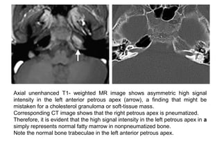 Axial unenhanced T1- weighted MR image shows asymmetric high signal
intensity in the left anterior petrous apex (arrow), a finding that might be
mistaken for a cholesterol granuloma or soft-tissue mass.
Corresponding CT image shows that the right petrous apex is pneumatized.
Therefore, it is evident that the high signal intensity in the left petrous apex in a
simply represents normal fatty marrow in nonpneumatized bone.
Note the normal bone trabeculae in the left anterior petrous apex.
 