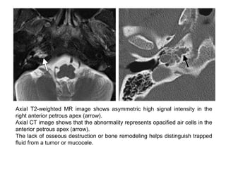 Axial T2-weighted MR image shows asymmetric high signal intensity in the
right anterior petrous apex (arrow).
Axial CT image shows that the abnormality represents opacified air cells in the
anterior petrous apex (arrow).
The lack of osseous destruction or bone remodeling helps distinguish trapped
fluid from a tumor or mucocele.
 