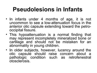 Pseudolesions in Infants
• In infants under 4 months of age, it is not
uncommon to see a low-attenuation focus in the
anterior otic capsule extending toward the petro-
occipital fissure.
• This hypoattenuation is a normal finding that
may represent incompletely mineralized bone or
cartilage and should not be mistaken for an
abnormality in young children.
• In older subjects, however, lucency around the
otic capsule should raise concern about a
pathologic condition such as retrofenestral
otosclerosis.
 