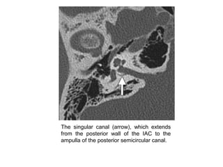 The singular canal (arrow), which extends
from the posterior wall of the IAC to the
ampulla of the posterior semicircular canal.
 