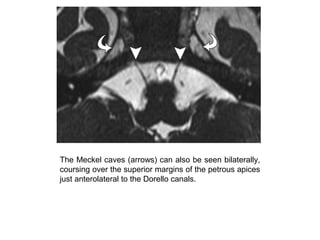 The Meckel caves (arrows) can also be seen bilaterally,
coursing over the superior margins of the petrous apices
just anterolateral to the Dorello canals.
 