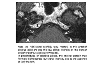 Note the high-signal-intensity fatty marrow in the anterior
petrous apex (*) and the low signal intensity of the denser
posterior petrous apex (arrowheads).
In pneumatized or sclerotic apices, the anterior portion may
normally demonstrate low signal intensity due to the absence
of fatty marrow.
 