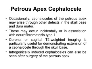 Petrous Apex Cephalocele
• Occasionally, cephaloceles of the petrous apex
may arise through other defects in the skull base
and dura mater.
• These may occur incidentally or in association
with neurofibromatosis type 1.
• Coronal or sagittal T2-weighted imaging is
particularly useful for demonstrating extension of
a cephalocele through the skull base.
• Iatrogenically induced cephaloceles can also be
seen after surgery of the petrous apex.
 