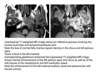 Unenhanced T1-weighted MR image shows an infiltrative process involving the
central skull base and temporomandibular joint.
Note the loss of normal fatty marrow signal intensity in the clivus and left petrous
apex.
There is fluid in the left mastoid.
Corresponding gadolinium-enhanced fat-suppressed T1-weighted MR image
shows intense enhancement of the left petrous apex and clivus as well as of the
soft tissues of the nasopharynx and left masticator space.
Note the enhancement of the left external auditory canal and periauricular soft
tissues (arrow).
 