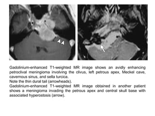Gadolinium-enhanced T1-weighted MR image shows an avidly enhancing
petroclival meningioma involving the clivus, left petrous apex, Meckel cave,
cavernous sinus, and sella turcica.
Note the thin dural tail (arrowheads).
Gadolinium-enhanced T1-weighted MR image obtained in another patient
shows a meningioma invading the petrous apex and central skull base with
associated hyperostosis (arrow).
 
