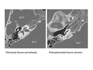 Petroclival fissure (arrowhead) Petrosphenoidal fissure (arrows)
 