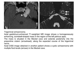 Trigeminal schwannoma.
Axial gadolinium-enhanced T1-weighted MR image shows a homogeneously
enhancing, dumbbell-shaped mass in the region of the left petrous apex.
The mass is situated in the Meckel cave and extends posteriorly into the
prepontine cistern (arrowhead), along the expected course of the trigeminal
nerve.
Axial CISS image obtained in another patient shows a cystic schwannoma with
multiple fluid levels (arrows) in the Meckel cave.
 