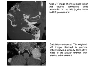 Axial CT image shows a mass lesion
that causes permeative bone
destruction in the left jugular fossa
and left petrous apex.
Gadolinium-enhanced T1- weighted
MR image obtained in another
patient shows a similarly destructive
mass of the jugular foramen with
intense enhancement.
 