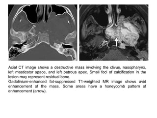 Axial CT image shows a destructive mass involving the clivus, nasopharynx,
left masticator space, and left petrous apex. Small foci of calcification in the
lesion may represent residual bone.
Gadolinium-enhanced fat-suppressed T1-weighted MR image shows avid
enhancement of the mass. Some areas have a honeycomb pattern of
enhancement (arrow).
 
