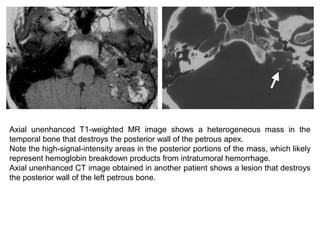 Axial unenhanced T1-weighted MR image shows a heterogeneous mass in the
temporal bone that destroys the posterior wall of the petrous apex.
Note the high-signal-intensity areas in the posterior portions of the mass, which likely
represent hemoglobin breakdown products from intratumoral hemorrhage.
Axial unenhanced CT image obtained in another patient shows a lesion that destroys
the posterior wall of the left petrous bone.
 