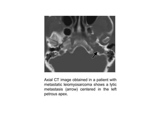 Axial CT image obtained in a patient with
metastatic leiomyosarcoma shows a lytic
metastasis (arrow) centered in the left
petrous apex.
 