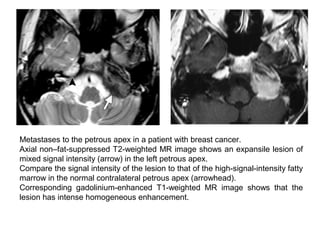 Metastases to the petrous apex in a patient with breast cancer.
Axial non–fat-suppressed T2-weighted MR image shows an expansile lesion of
mixed signal intensity (arrow) in the left petrous apex.
Compare the signal intensity of the lesion to that of the high-signal-intensity fatty
marrow in the normal contralateral petrous apex (arrowhead).
Corresponding gadolinium-enhanced T1-weighted MR image shows that the
lesion has intense homogeneous enhancement.
 