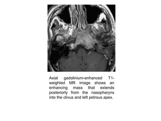 Axial gadolinium-enhanced T1-
weighted MR image shows an
enhancing mass that extends
posteriorly from the nasopharynx
into the clivus and left petrous apex.
 