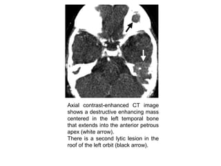Axial contrast-enhanced CT image
shows a destructive enhancing mass
centered in the left temporal bone
that extends into the anterior petrous
apex (white arrow).
There is a second lytic lesion in the
roof of the left orbit (black arrow).
 