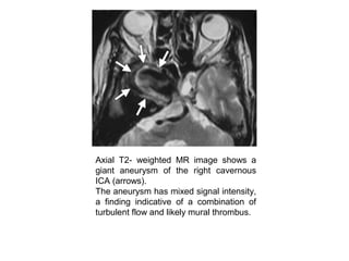 Axial T2- weighted MR image shows a
giant aneurysm of the right cavernous
ICA (arrows).
The aneurysm has mixed signal intensity,
a finding indicative of a combination of
turbulent flow and likely mural thrombus.
 
