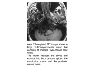 Axial T1-weighted MR image shows a
large multicompartmental lesion that
consists of multiple hypointense flow
voids.
The lesion replaces the clivus and
extends into both petrous apices, the
masticator space, and the posterior
cranial fossa.
 