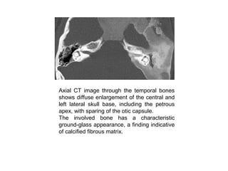 Axial CT image through the temporal bones
shows diffuse enlargement of the central and
left lateral skull base, including the petrous
apex, with sparing of the otic capsule.
The involved bone has a characteristic
ground-glass appearance, a finding indicative
of calcified fibrous matrix.
 
