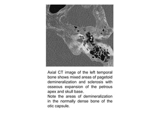 Axial CT image of the left temporal
bone shows mixed areas of pagetoid
demineralization and sclerosis with
osseous expansion of the petrous
apex and skull base.
Note the areas of demineralization
in the normally dense bone of the
otic capsule.
 