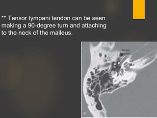 ** Tensor tympani tendon can be seen
making a 90-degree turn and attaching
to the neck of the malleus.
 