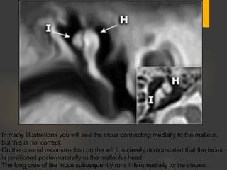 In many illustrations you will see the incus connecting medially to the malleus,
but this is not correct.
On the coronal reconstruction on the left it is clearly demonstated that the incus
is positioned posterolaterally to the malleolar head.
The long crus of the incus subsequently runs inferomedially to the stapes.
 