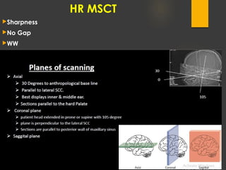 HR MSCT
Sharpness
No Gap
WW
WL
 