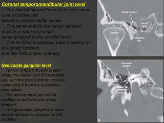 Coronal temporomandibular joint level
 The horizontal carotid canal is seen as an
oval structure just
lateral to petrooccipital suture.
 The semicanal for the tensor tympani
muscle is seen as a small
lucency lateral to the carotid canal.
 The air-filled eustachian tube is inferior to
the tensor tympani,
and the TMJ is seen laterally
Geniculate ganglion level
 Tensor tympani muscle is seen
along the medial wall of the middle
ear, with the cochleariform process
separating it from the eustachian
tube below.
 The anteriormost part of the
cochlea is medial to the tensor
tympani.
 The geniculate ganglion is seen
as a small lucency superior to the
cochlea
 
