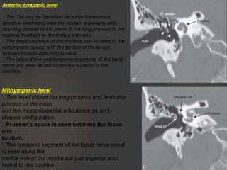 Anterior tympanic level
The TM may be identified as a thin filamentous
structure extending from the scutum superiorly and
coursing parallel to the plane of the long process of the
malleus to attach to the limbus inferiorly.
The head and neck of the malleus can be seen in the
epitympanic space, with the tendon of the tensor
tympani muscle attaching to neck.
The labyrinthine and tympanic segments of the facial
nerve are seen as two lucencies superior to the
cochlea.
Midtympanic level
This level shows the long process and lenticular
process of the incus
and the incudostapedial articulation as an L-
shaped configuration.
Prussak’s space is seen between the incus
and
scutum.
The tympanic segment of the facial nerve canal
is seen along the
medial wall of the middle ear just superior and
lateral to the cochlea.
 