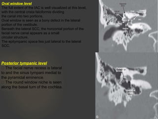 Oval window level
The full extent of the IAC is well visualized at this level,
with the central crista falciformis dividing
the canal into two portions.
Oval window is seen as a bony defect in the lateral
portion of the vestibule.
Beneath the lateral SCC, the horizontal portion of the
facial nerve canal appears as a small
circular structure.
The epitympanic space lies just lateral to the lateral
SCC.
Posterior tympanic level
 The facial nerve recess is lateral
to and the sinus tympani medial to
the pyramidal eminence.
 The round window niche is seen
along the basal turn of the cochlea.
 