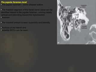The jugular foramen level
•The jugular foramen – dome shaped outline.
•The mastoid segment of the facial nerve canal can be
identified lateral to the jugular foramen, running nearly
vertical and extending toward the stylomastoid
•foramen.
•The mastoid antrum is seen superiorly and laterally.
•Portions of the lateral and
•superior SCCs can be seen.
 