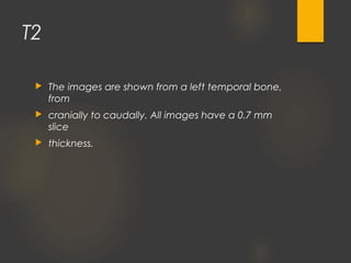 T2
 The images are shown from a left temporal bone,
from
 cranially to caudally. All images have a 0.7 mm
slice
 thickness.
 