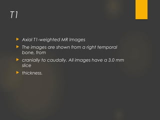 T1
 Axial T1-weighted MR Images
 The images are shown from a right temporal
bone, from
 cranially to caudally. All images have a 3.0 mm
slice
 thickness.
 