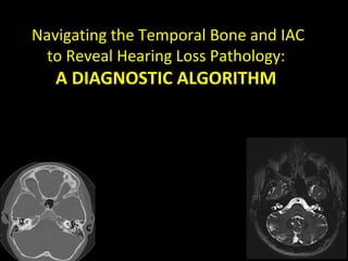 Navigating the Temporal Bone and IAC
to Reveal Hearing Loss Pathology:
A DIAGNOSTIC ALGORITHM
 