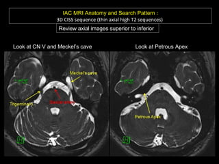 IAC MRI Anatomy and Search Pattern :
3D CISS sequence (thin axial high T2 sequences)
Review axial images superior to inferior
Look at CN V and Meckel’s cave Look at Petrous Apex
 