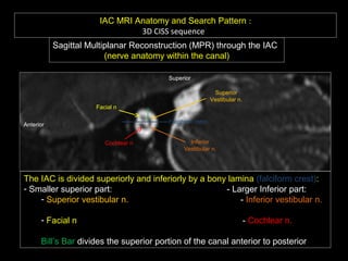 IAC MRI Anatomy and Search Pattern :
3D CISS sequence
Sagittal Multiplanar Reconstruction (MPR) through the IAC
(nerve anatomy within the canal)
Anterior
Superior
Facial n
Cochlear n
Superior
Vestibular n.
Inferior
Vestibular n.
The IAC is divided superiorly and inferiorly by a bony lamina (falciform crest):
- Smaller superior part: - Larger Inferior part:
- Superior vestibular n. - Inferior vestibular n.
- Facial n - Cochlear n.
Bill’s Bar divides the superior portion of the canal anterior to posterior
Falciform crest
 