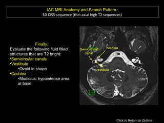 IAC MRI Anatomy and Search Pattern :
3D CISS sequence (thin axial high T2 sequences)
Finally:
Evaluate the following fluid filled
structures that are T2 bright:
•Semicircular canals
•Vestibule
•Ovoid in shape
•Cochlea
•Modiolus: hypointense area
at base
Click to Return to Outline
 