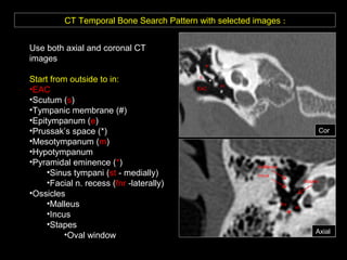 CT Temporal Bone Search Pattern with selected images :
Use both axial and coronal CT
images
Start from outside to in:
•EAC
•Scutum (s)
•Tympanic membrane (#)
•Epitympanum (e)
•Prussak’s space (*)
•Mesotympanum (m)
•Hypotympanum
•Pyramidal eminence (*)
•Sinus tympani (st - medially)
•Facial n. recess (fnr -laterally)
•Ossicles
•Malleus
•Incus
•Stapes
•Oval window
s
m
*
e
st
fnr
Cor
Axial
*
stapes
incus
malleous
EAC
#
 
