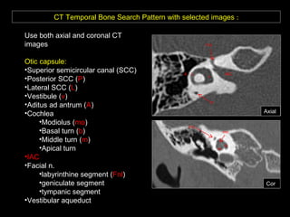 CT Temporal Bone Search Pattern with selected images :
Use both axial and coronal CT
images
Otic capsule:
•Superior semicircular canal (SCC)
•Posterior SCC (P)
•Lateral SCC (L)
•Vestibule (v)
•Aditus ad antrum (A)
•Cochlea
•Modiolus (mo)
•Basal turn (b)
•Middle turn (m)
•Apical turn
•IAC
•Facial n.
•labyrinthine segment (Fnl)
•geniculate segment
•tympanic segment
•Vestibular aqueduct
v
IAC
b
m
mo
Fnl
Cor
Axial
Fnl
L
P
A
 