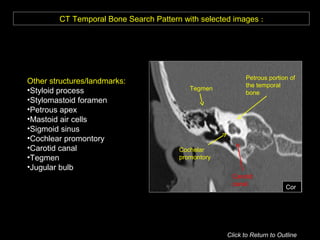 CT Temporal Bone Search Pattern with selected images :
Other structures/landmarks:
•Styloid process
•Stylomastoid foramen
•Petrous apex
•Mastoid air cells
•Sigmoid sinus
•Cochlear promontory
•Carotid canal
•Tegmen
•Jugular bulb
Tegmen
Petrous portion of
the temporal
bone
Cochelar
promontory
Carotid
canal
Cor
Click to Return to Outline
 