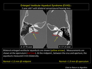 Enlarged Vestibular Aqueduct Syndrome (EVAS) :
2 year old F with bilateral sensorineural hearing loss.
B: CT Lft axialA: CT Rt axial
Bilateral enlarged vestibular aqueducts are shown (yellow arrows). Measurements are
shown at the operculum (red lines). At the midpoint , between the crus and aperture, the
aqueducts measured 3 mm bilaterally.
Normal < 1.5 mm @ midpoint Normal < 1.9 mm @ operculum
Click to Return to Algorithm
6mm
5 mm
 