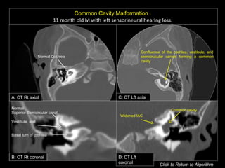Common Cavity Malformation :
11 month old M with left sensorineural hearing loss.
A: CT Rt axial C: CT Lft axial
B: CT Rt coronal D: CT Lft
coronal
Confluence of the cochlea, vestibule, and
semicirucular canals forming a common
cavity
Common cavity
Widened IAC
Normal Cochlea
Normal:
Superior Semicircular canal,
Vestibule, and
Basal turn of cochlea
Click to Return to Algorithm
 