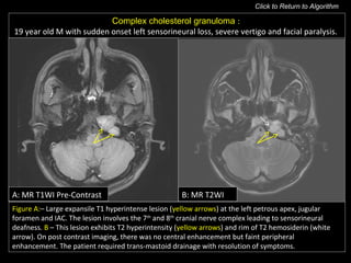 A: MR T1WI Pre-Contrast
Figure A:– Large expansile T1 hyperintense lesion (yellow arrows) at the left petrous apex, jugular
foramen and IAC. The lesion involves the 7th
and 8th
cranial nerve complex leading to sensorineural
deafness. B – This lesion exhibits T2 hyperintensity (yellow arrows) and rim of T2 hemosiderin (white
arrow). On post contrast imaging, there was no central enhancement but faint peripheral
enhancement. The patient required trans-mastoid drainage with resolution of symptoms.
Complex cholesterol granuloma :
19 year old M with sudden onset left sensorineural loss, severe vertigo and facial paralysis.
B: MR T2WI
Click to Return to Algorithm
 