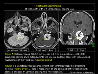 Vestibular Schwanoma :
44 year old M with left sensorineural hearing loss.
A: MR axial T2 FLAIR B: MR axial T1 Post C: MR cor T1 Post
Figure A: Heterogeneous, FLAIR hyperintense 4.8 cm extra-axial mass in the left
cerebellar pontine angle extending into the internal auditory canal with widening and
involvement of the vestibular n. (yellow arrow)
Figures B & C: Heterogeneous enhancement with central cavitation representing
necrosis (yellow arrows). There is mass effect on the pons and left cerebellum with
stenosis of upper 4th
ventricle causing mild hydrocephalus. Click to Return to Algorithm
 