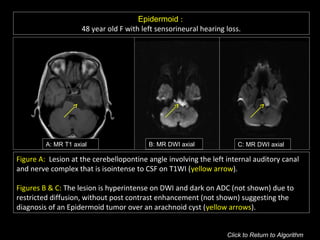 Epidermoid :
48 year old F with left sensorineural hearing loss.
A: MR T1 axial B: MR DWI axial C: MR DWI axial
Figure A: Lesion at the cerebellopontine angle involving the left internal auditory canal
and nerve complex that is isointense to CSF on T1WI (yellow arrow).
Figures B & C: The lesion is hyperintense on DWI and dark on ADC (not shown) due to
restricted diffusion, without post contrast enhancement (not shown) suggesting the
diagnosis of an Epidermoid tumor over an arachnoid cyst (yellow arrows).
Click to Return to Algorithm
 