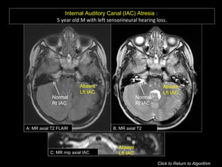 Internal Auditory Canal (IAC) Atresia :
5 year old M with left sensorineural hearing loss.
A: MR axial T2 FLAIR B: MR axial T2
C: MR mip axial IAC
Absent
Lft IAC
Absent
Lft IAC
Normal
Rt IAC
Normal
Rt IAC
Absent
Lft IAC
Click to Return to Algorithm
 
