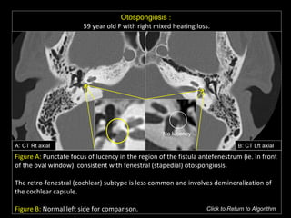 Otospongiosis :
59 year old F with right mixed hearing loss.
A: CT Rt axial B: CT Lft axial
Figure A: Punctate focus of lucency in the region of the fistula antefenestrum (ie. In front
of the oval window) consistent with fenestral (stapedial) otospongiosis.
The retro-fenestral (cochlear) subtype is less common and involves demineralization of
the cochlear capsule.
Figure B: Normal left side for comparison. Click to Return to Algorithm
No lucency
 
