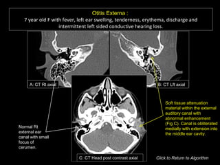 Otitis Externa :
7 year old F with fever, left ear swelling, tenderness, erythema, discharge and
intermittent left sided conductive hearing loss.
B: CT Lft axialA: CT Rt axial
C: CT Head post contrast axial
Normal Rt
external ear
canal with small
focus of
cerumen.
Soft tissue attenuation
material within the external
auditory canal with
abnormal enhancement
(Fig C). Canal is obliterated
medially with extension into
the middle ear cavity.
Click to Return to Algorithm
 