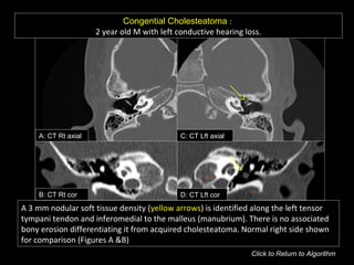 Congential Cholesteatoma :
2 year old M with left conductive hearing loss.
A: CT Rt axial C: CT Lft axial
B: CT Rt cor D: CT Lft cor
A 3 mm nodular soft tissue density (yellow arrows) is identified along the left tensor
tympani tendon and inferomedial to the malleus (manubrium). There is no associated
bony erosion differentiating it from acquired cholesteatoma. Normal right side shown
for comparison (Figures A &B)
Click to Return to Algorithm
 