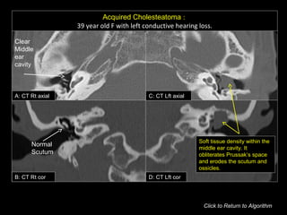 Acquired Cholesteatoma :
39 year old F with left conductive hearing loss.
Click to Return to Algorithm
A: CT Rt axial
B: CT Rt cor
C: CT Lft axial
D: CT Lft cor
Normal
Scutum
Soft tissue density within the
middle ear cavity. It
obliterates Prussak’s space
and erodes the scutum and
ossicles.
Clear
Middle
ear
cavity
 